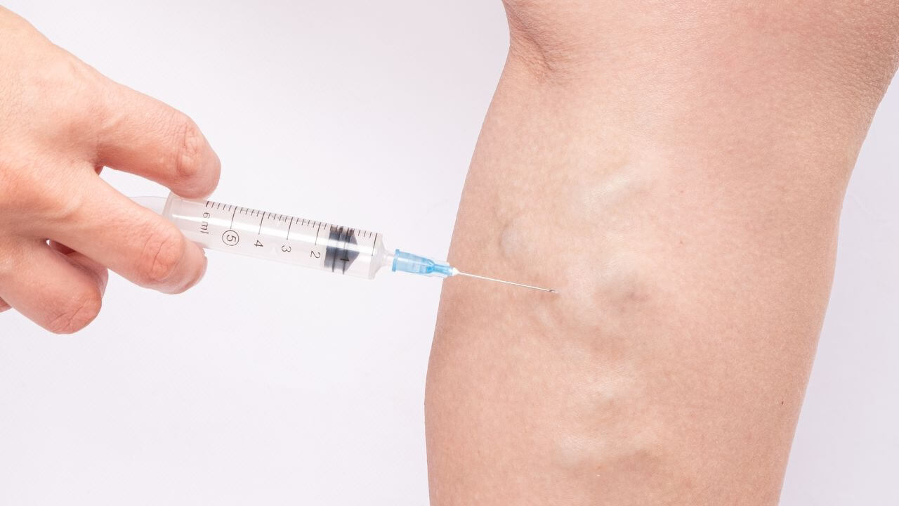 Varicose Vein Treatments 6 Steps For Insurance Coverage iThriveveins